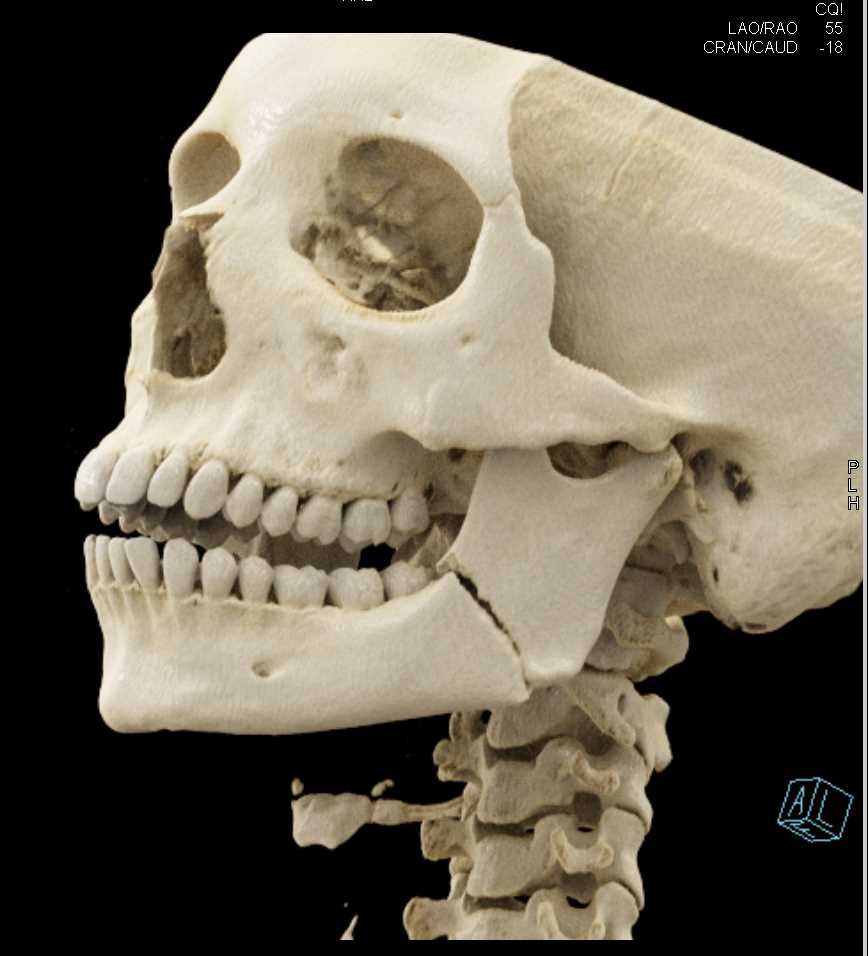 Mandibular Fracture - CTisus CT Scan