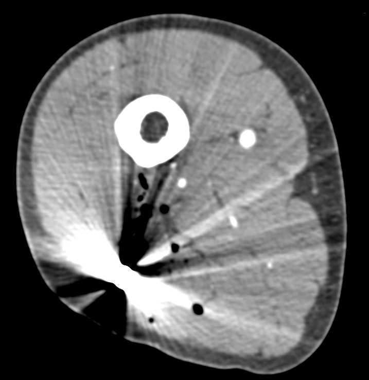 Gunshot Wound (GSW) Thigh Without Vascular Injury - CTisus CT Scan