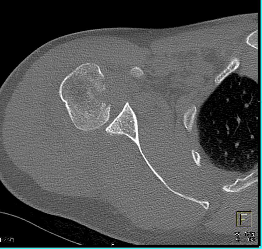 Humerus Fracture with Dislocation - CTisus CT Scan