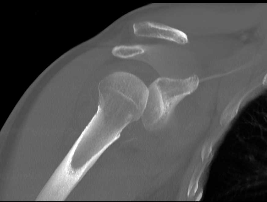 Humerus Fracture with Dislocation - CTisus CT Scan