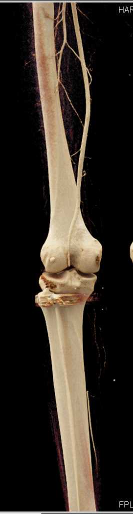 GSW Thigh Without Vascular Injury using Cinematic Rendering - CTisus CT Scan