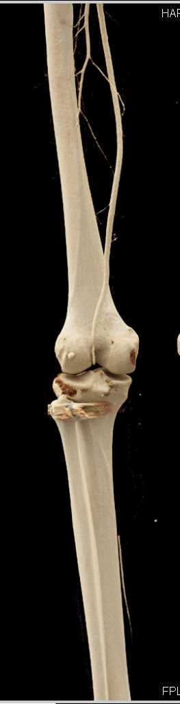 GSW Thigh Without Vascular Injury using Cinematic Rendering - CTisus CT Scan