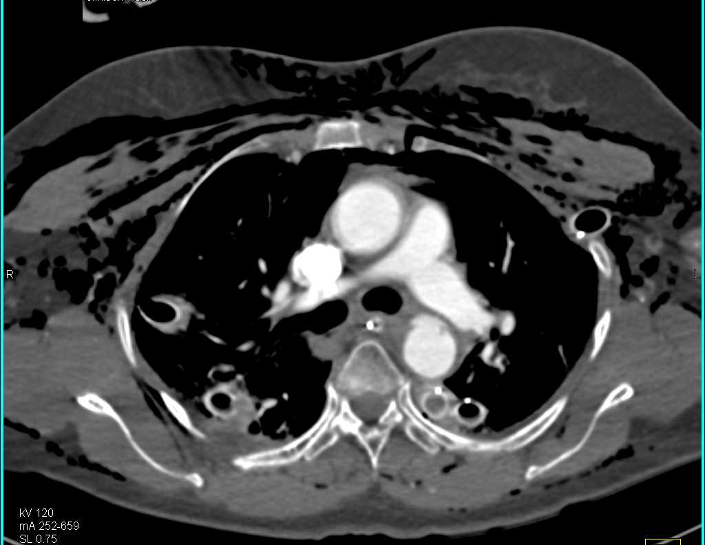 Motor Vehicle Accident (MVA) with Chest and Aortic Trauma - CTisus CT Scan