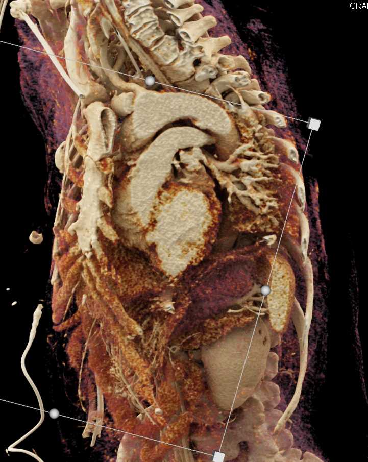 Motor Vehicle Accident (MVA) with Chest and Aortic Trauma - CTisus CT Scan