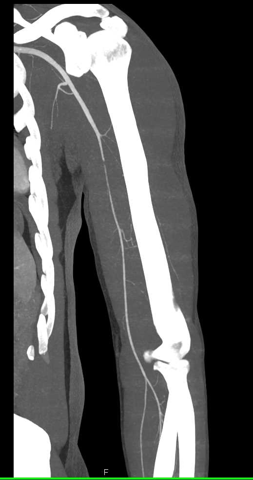 Trauma with Spasm in the Brachial Artery - CTisus CT Scan