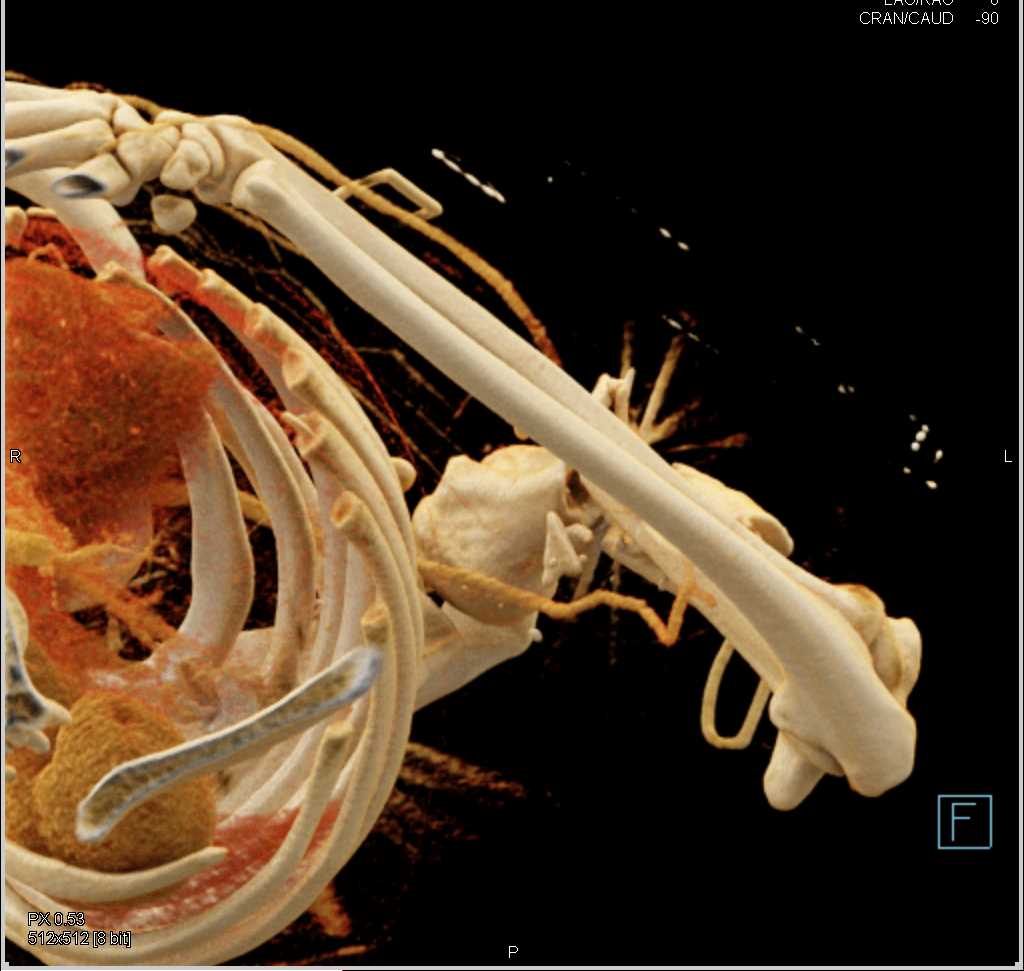 Gunshot Wound (GSW) Humerus with Fracture but no Vascular Injury Using Cinematic Rendering - CTisus CT Scan