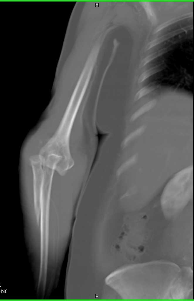 Fracture Dislocation Elbow Joint - CTisus CT Scan