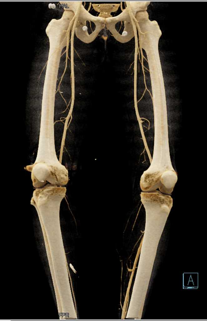 Gunshot Wound (GSW) Thigh Without Vascular Injury with CTA - CTisus CT Scan