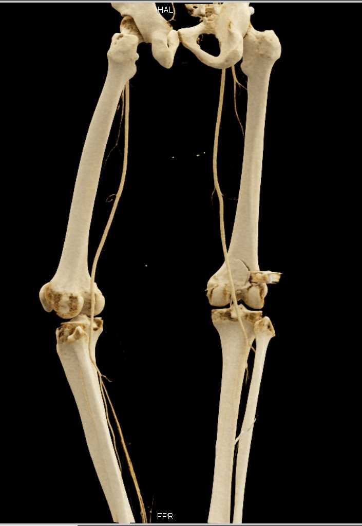 Gunshot Wound (GSW) Thigh Without Vascular Injury with CTA but Femur Fracture - CTisus CT Scan