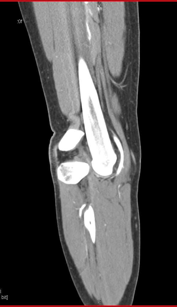 Fracture Dislocation at the Knee Joint - CTisus CT Scan