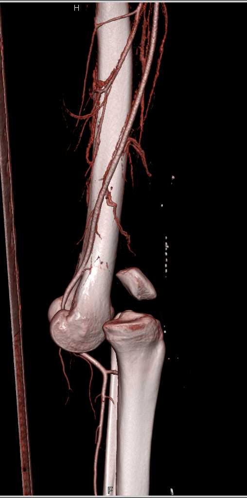 Fracture Dislocation at the Knee Joint - CTisus CT Scan