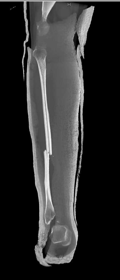 Spiral Fractures of the Tibia and Fibula - CTisus CT Scan