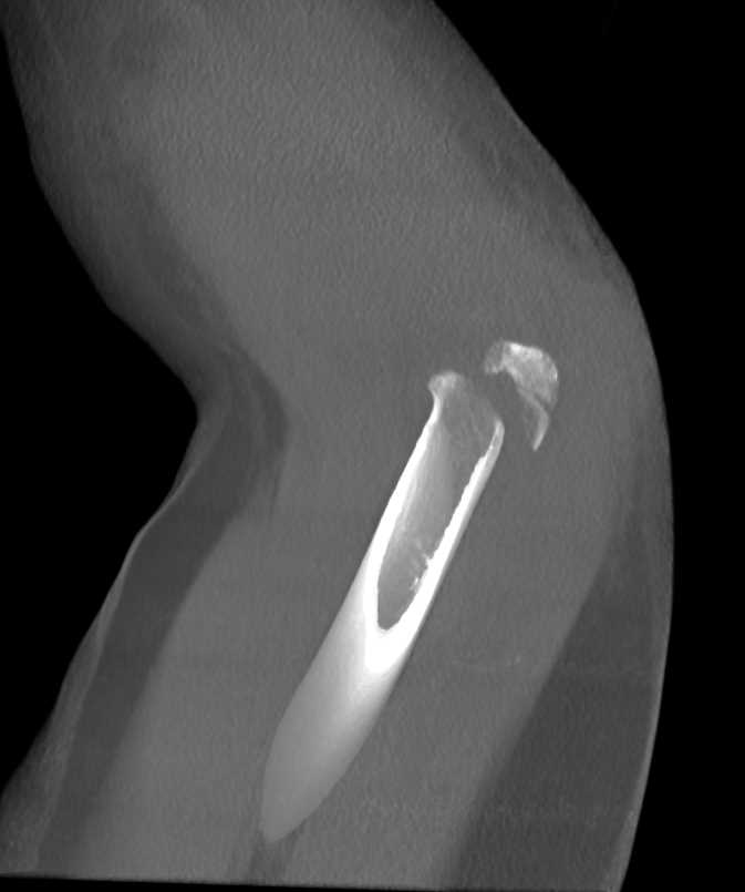 Comminuted Fracture and Dislocation Elbow - CTisus CT Scan