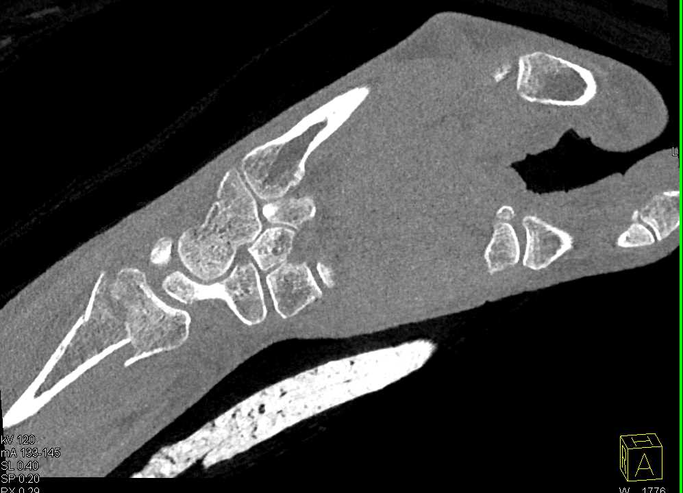 Distal Radius Fracture - CTisus CT Scan