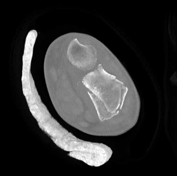 Distal Radius Fracture - CTisus CT Scan
