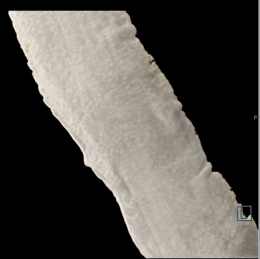 Distal Humerus Fracture in Cast - CTisus CT Scan