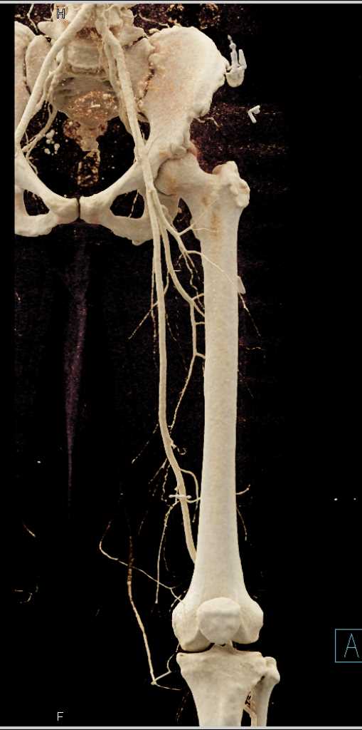 Glass Fragments in Posterior Thigh - CTisus CT Scan