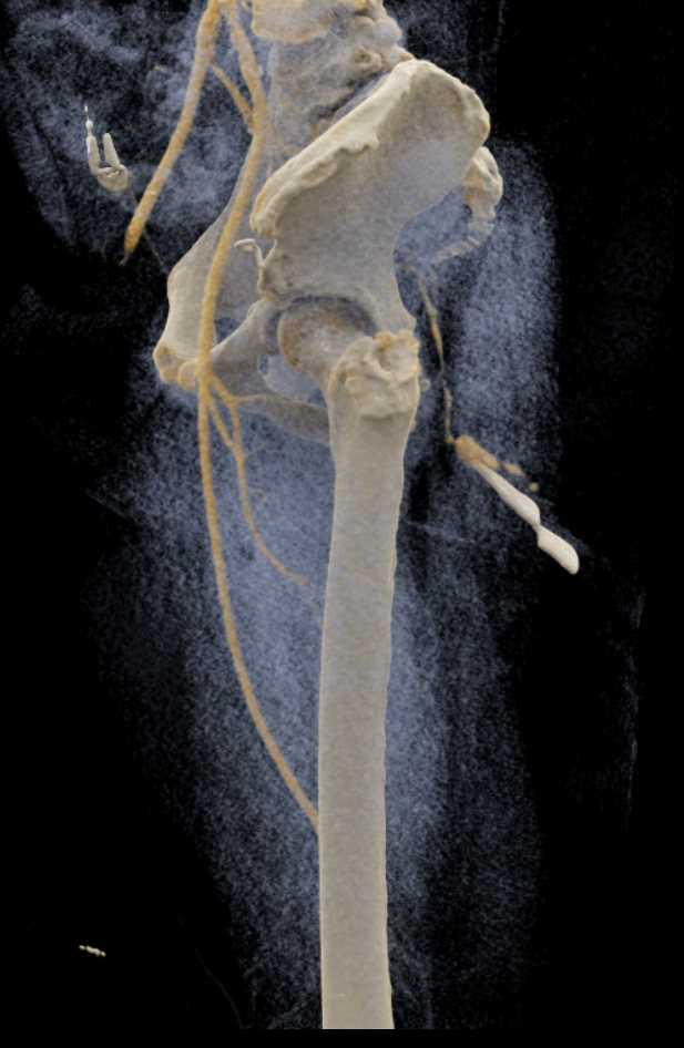 Active Bleed Buttocks due to Broken Glass with Vascular Injury - CTisus CT Scan