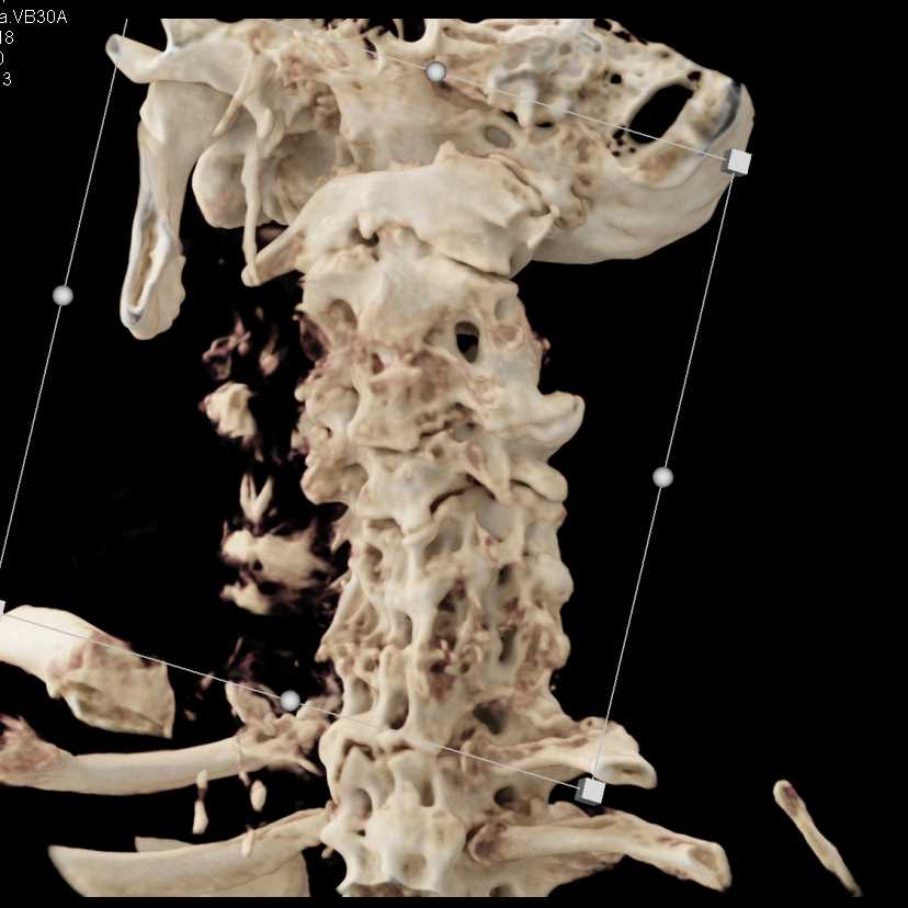 Odontoid Fracture - CTisus CT Scan