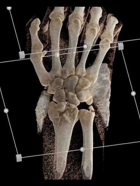 Distal Radius and Ulnar Fracture - CTisus CT Scan