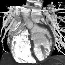 Aberrant Right Coronary Artery - CTisus CT Scan