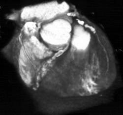 Diseased Coronary Arteries - CTisus CT Scan