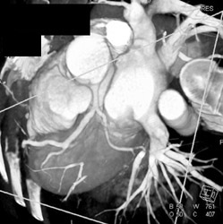 Normal CT Angiogram - CTisus CT Scan