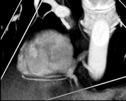 Right Coronary Artery - CTisus CT Scan