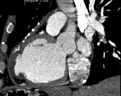 Left Ventricular Aneurysm - CTisus CT Scan