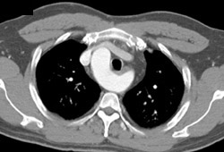 Right Aortic Arch - CTisus CT Scan