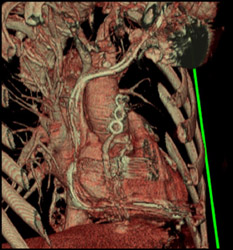 Coronary Artery Grafts - CTisus CT Scan