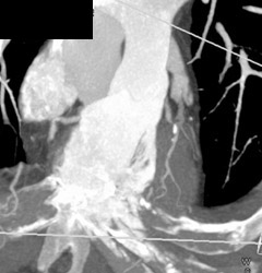 Calcified Plaque in Right Coronary Artery - CTisus CT Scan