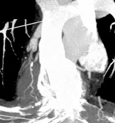 Diseased Right Coronary Artery - CTisus CT Scan