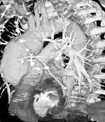 Coronary Artery Bypass Graft - CTisus CT Scan