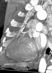 Normal Internal Mammary Artery - CTisus CT Scan