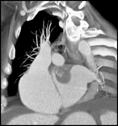 Atrial Myxoma - CTisus CT Scan