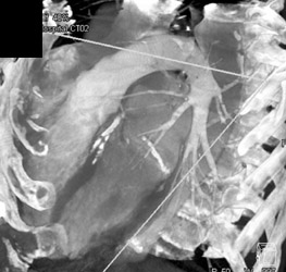 Coronary Artery Stents - CTisus CT Scan