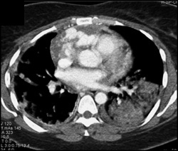 Angiosarcoma of the Heart - CTisus CT Scan