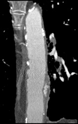 Focal Dissection - CTisus CT Scan