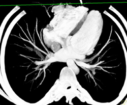 MIP of Pulmonary Vasculature - CTisus CT Scan