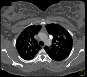 Persistent Left Superior Vena Cava (SVC) - CTisus CT Scan