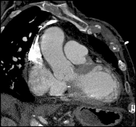 Coronary Artery Disease - CTisus CT Scan