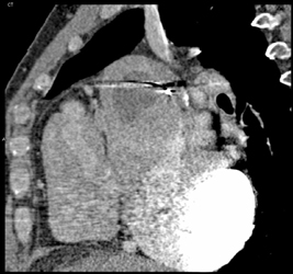 Clot in Left Atrium - CTisus CT Scan