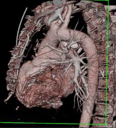 Normal Arch - CTisus CT Scan