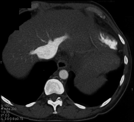 Reflux Into Inferior Vena Cava (IVC) - CTisus CT Scan