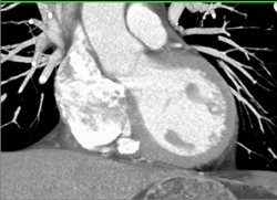 Normal Left Ventricle - CTisus CT Scan