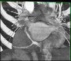 Coronary Sinus - CTisus CT Scan