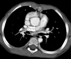 Stent in Pulmonary Artery - CTisus CT Scan