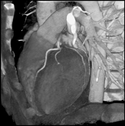 Normal LAD and Circumflex - CTisus CT Scan