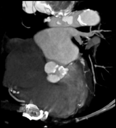 Aortic Stenosis - CTisus CT Scan